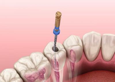 آشنایی با روش نوین عصب کشی دندان