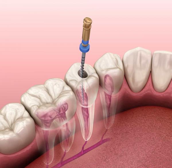 آشنایی با روش نوین عصب کشی دندان