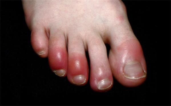 انگشت پای کوویدی چیست