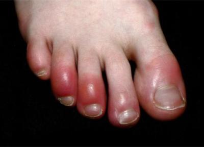انگشت پای کوویدی چیست